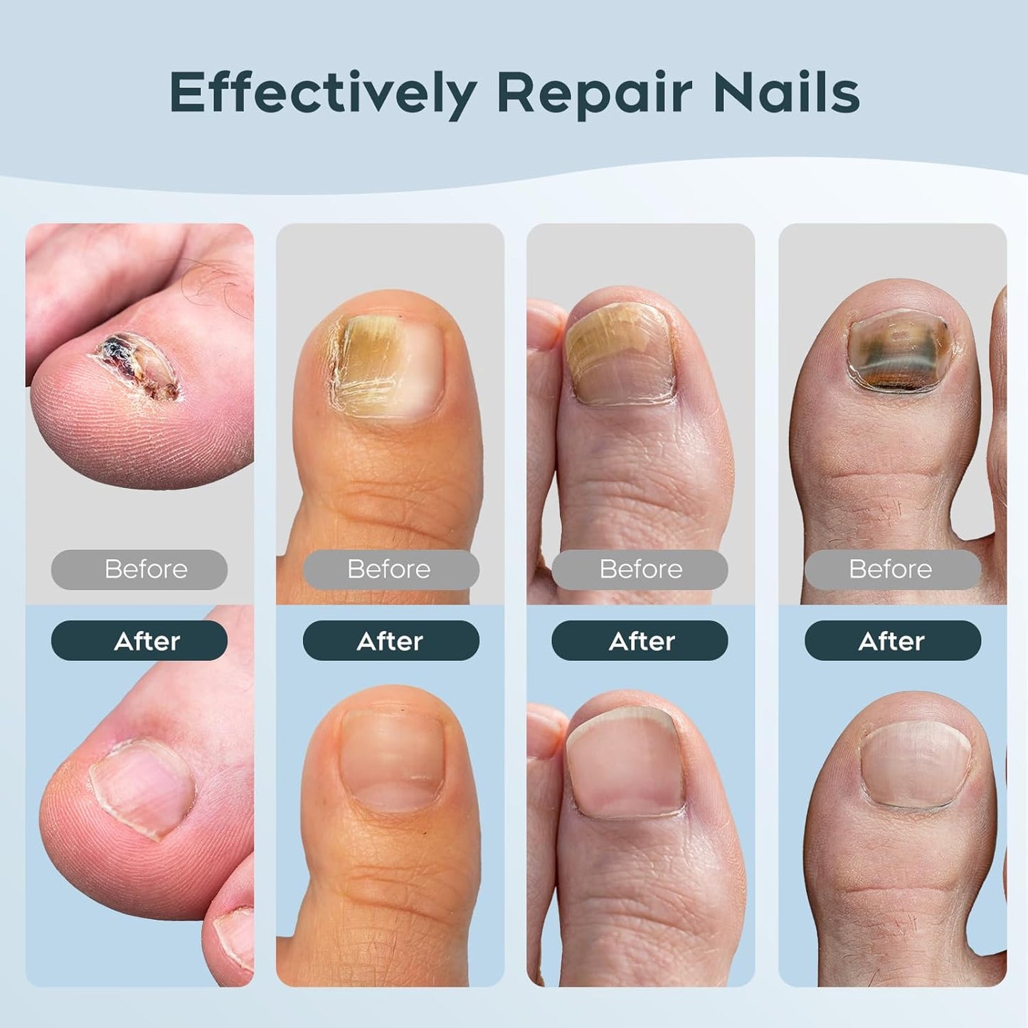 FungGone™ - LED Therapy Nail Fungus Device