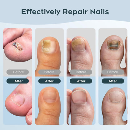 FungGone™ - LED Therapy Nail Fungus Device